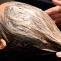 الزنجبيل و علاج تساقط الشعر و القشرة